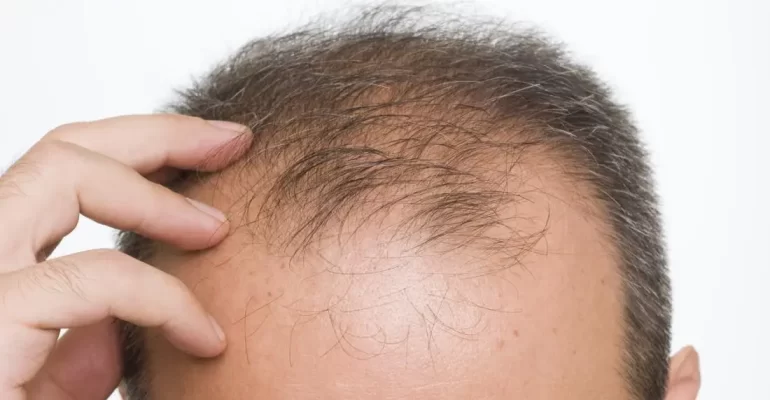a-man-experiencing-hair-loss